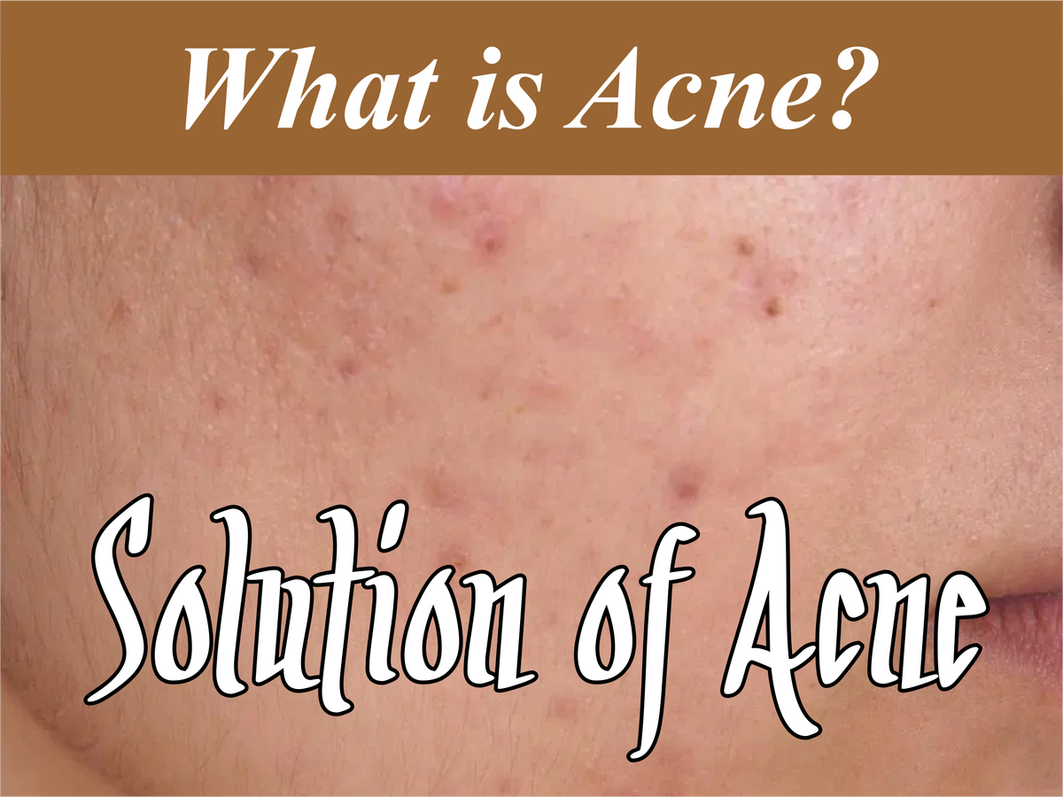 What Is Acne? Is This Disease? – Colorline Cosmeceutical